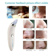 Derma Suction Blackhead Remover Vacuum Suck The Yuck Out Of Your Pores (cell Operated )